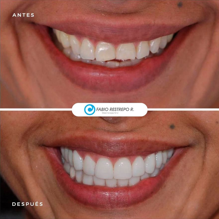 Antes y después — caso 2